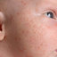 Diagnostic Tools to Use When We Suspect an Allergic Reaction to a