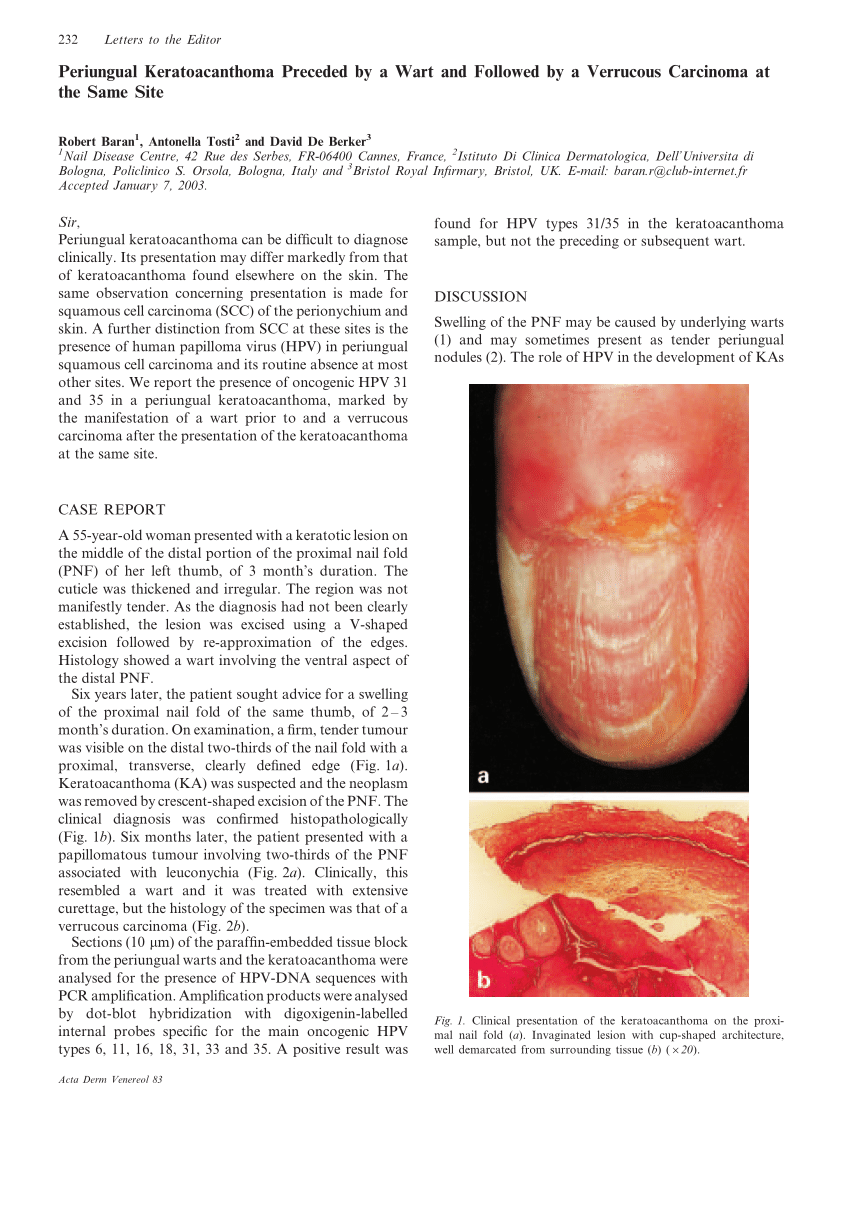Human papillomavirus in keratoacanthoma