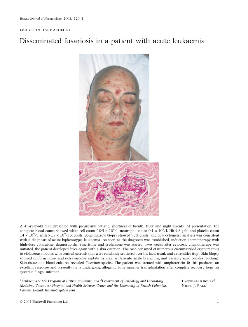(PDF) Disseminated fusariosis in a patient with acute leukaemia