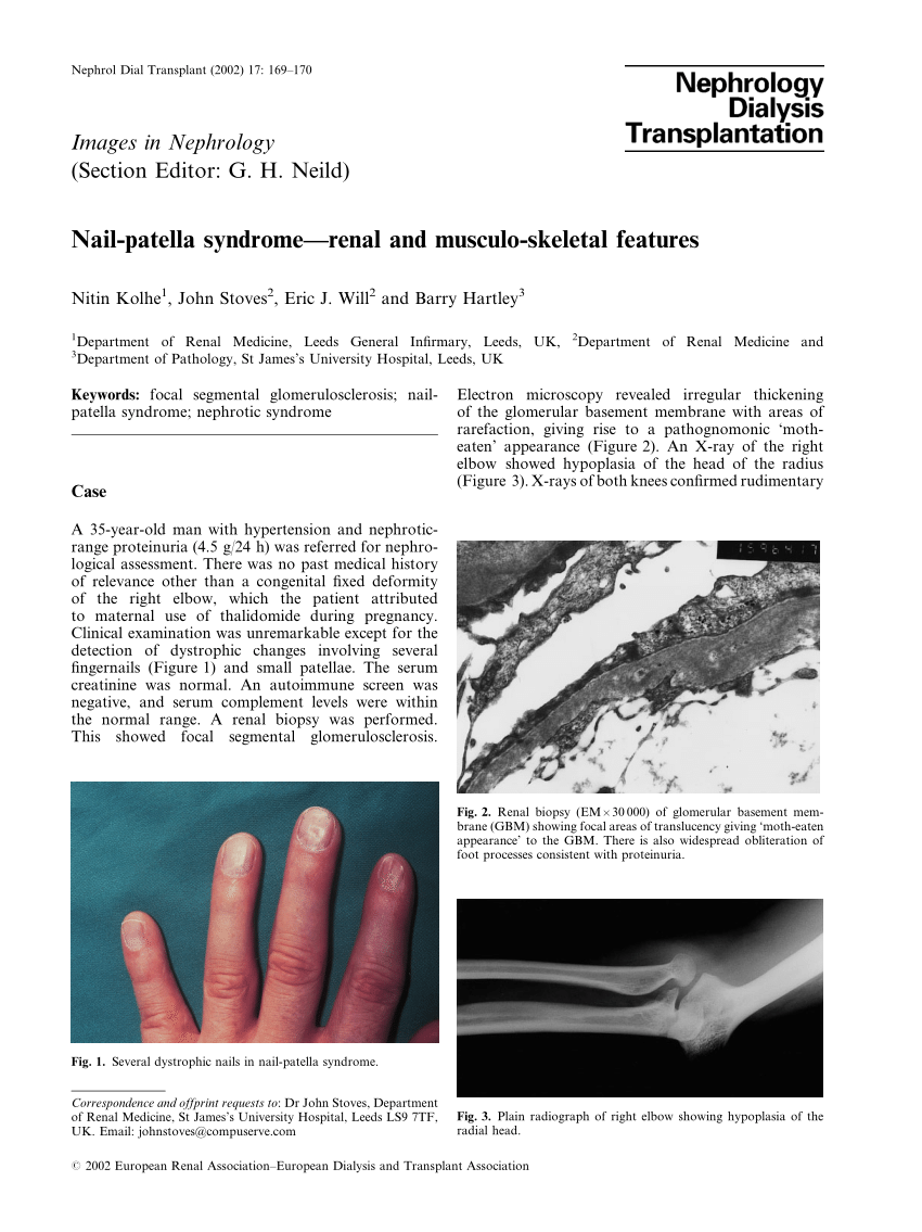 Cureus | Nail-Patella Syndrome: A Case Series From Northern India | Article