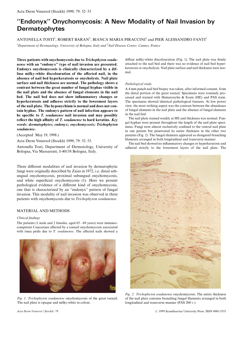 A gombás körömfertőzés (Onychomycosis) - Bőrbetegségek és szépség 