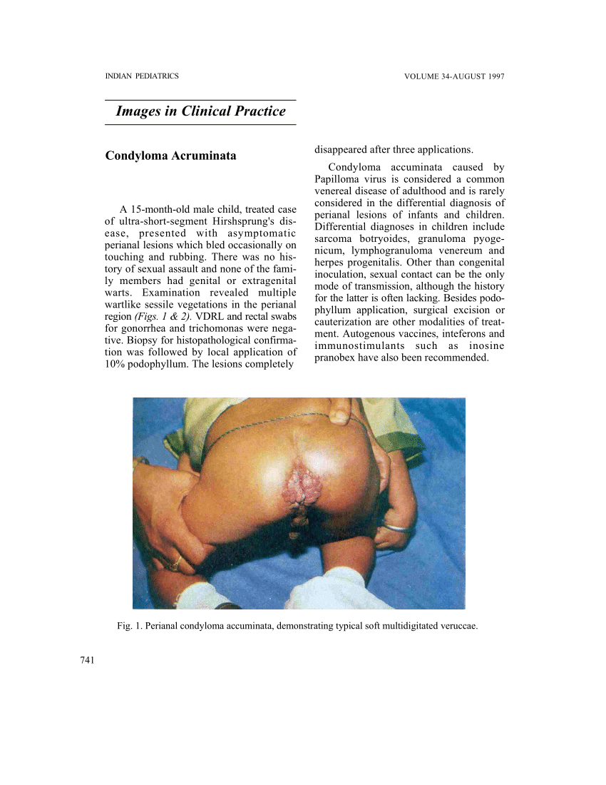 Condyloma cauterization után - A condylomák kezelése és eltávolítása