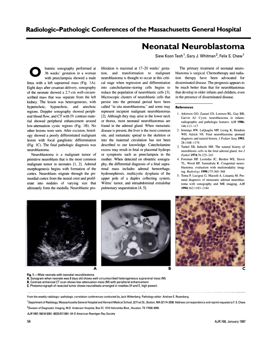 neonatal neuroblastoma presentation