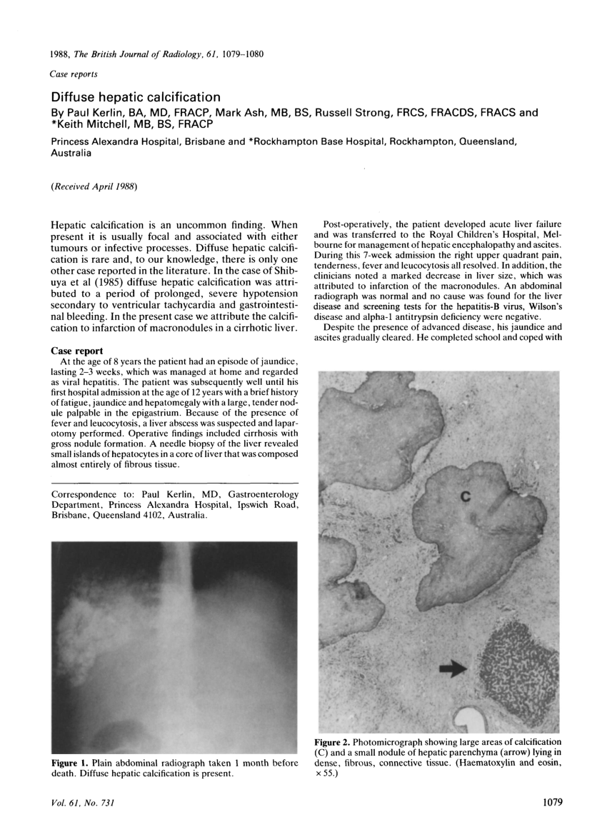 (PDF) Diffuse hepatic calcification