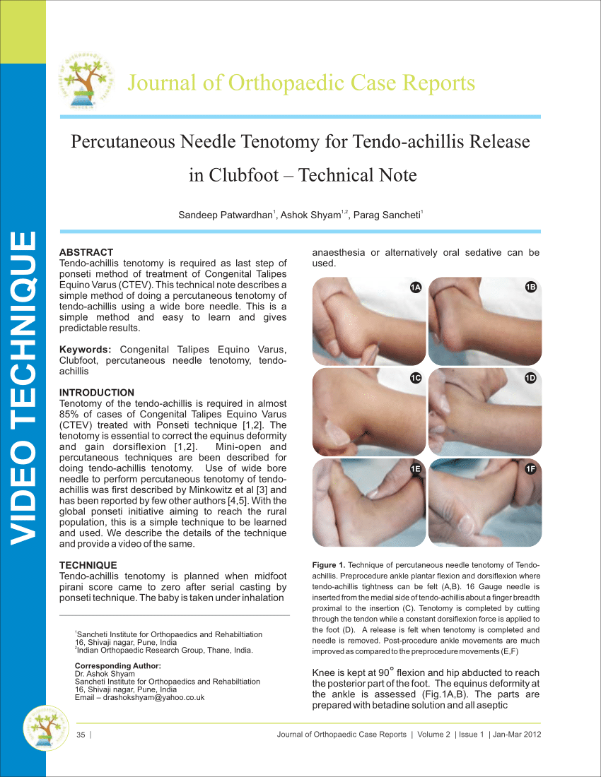 Pdf Percutaneous Needle Tenotomy For Tendo Achillis Release In Cases Of Clubfoot Technical Note