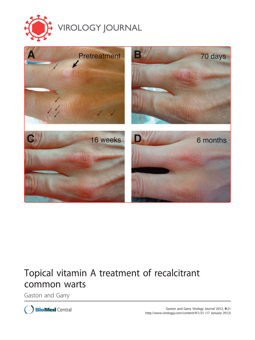 warts on hands vitamin deficiency