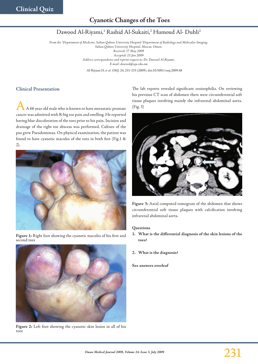 Pdf Cyanotic Changes Of The Toes