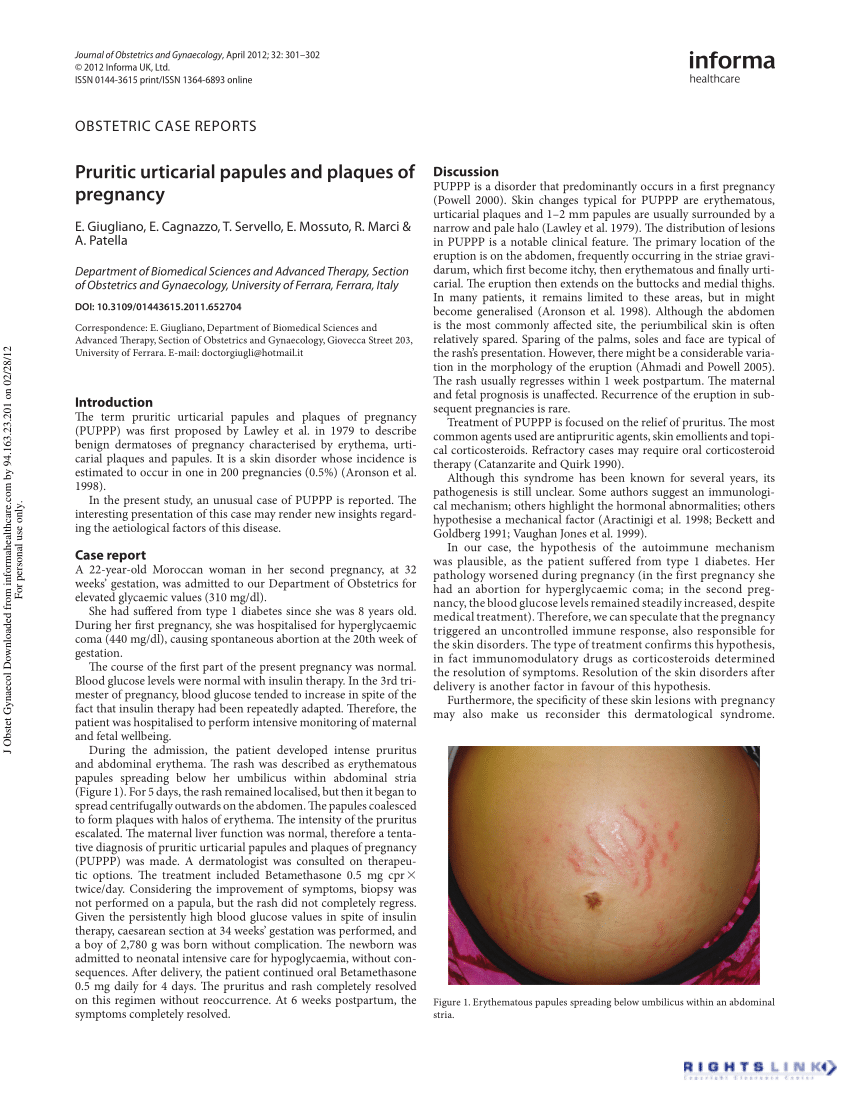 Pruritic Urticarial Papules and Plaques of Pregnancy - American