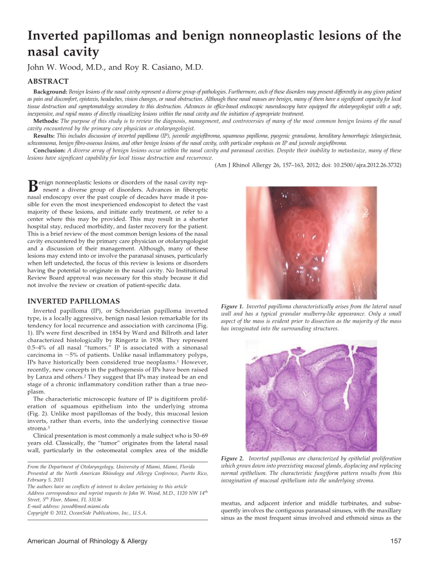 nasal viral papilloma