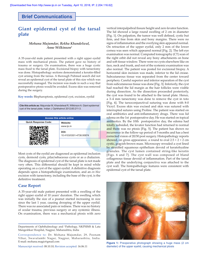 Pdf Giant Epidermal Cyst Of The Tarsal Plate