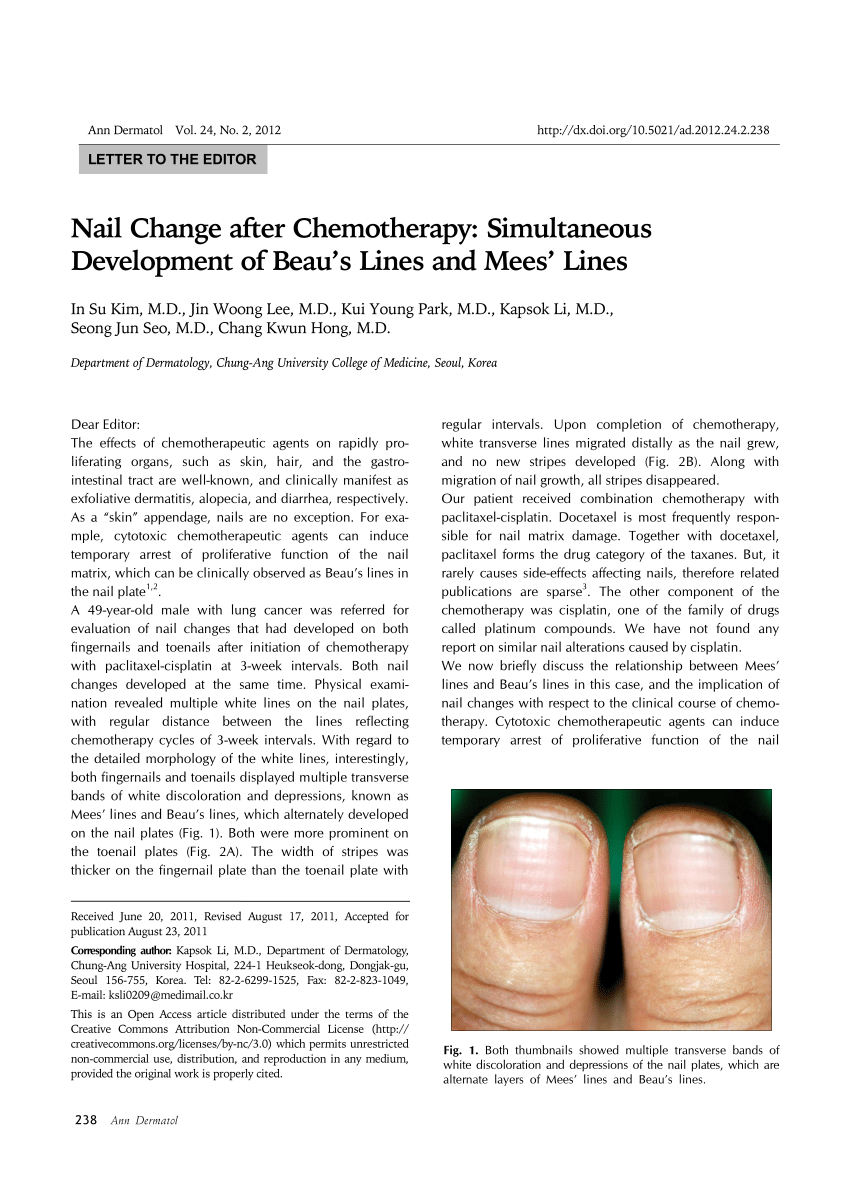 Nail Change after Chemotherapy: Simultaneous Development of Beau's Lines  and Mees' Lines