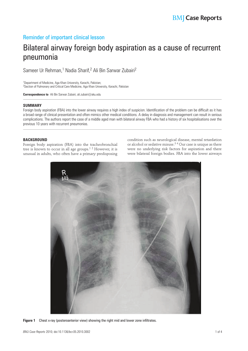 a of cause body PDF) foreign as ... aspiration airway Bilateral