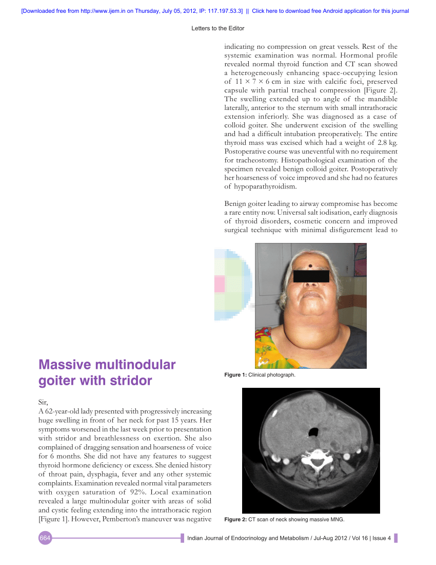 Pdf Massive Multinodular Goiter With Stridor