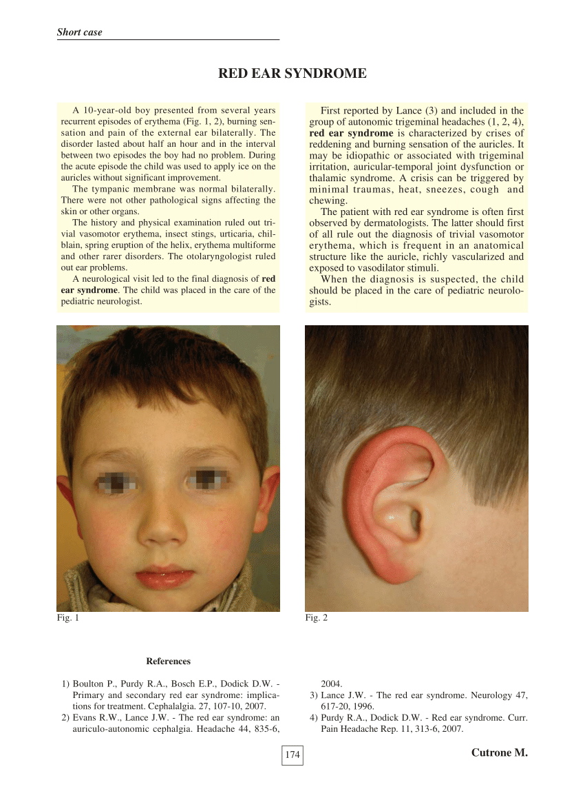 Pdf Red Ear Syndrome