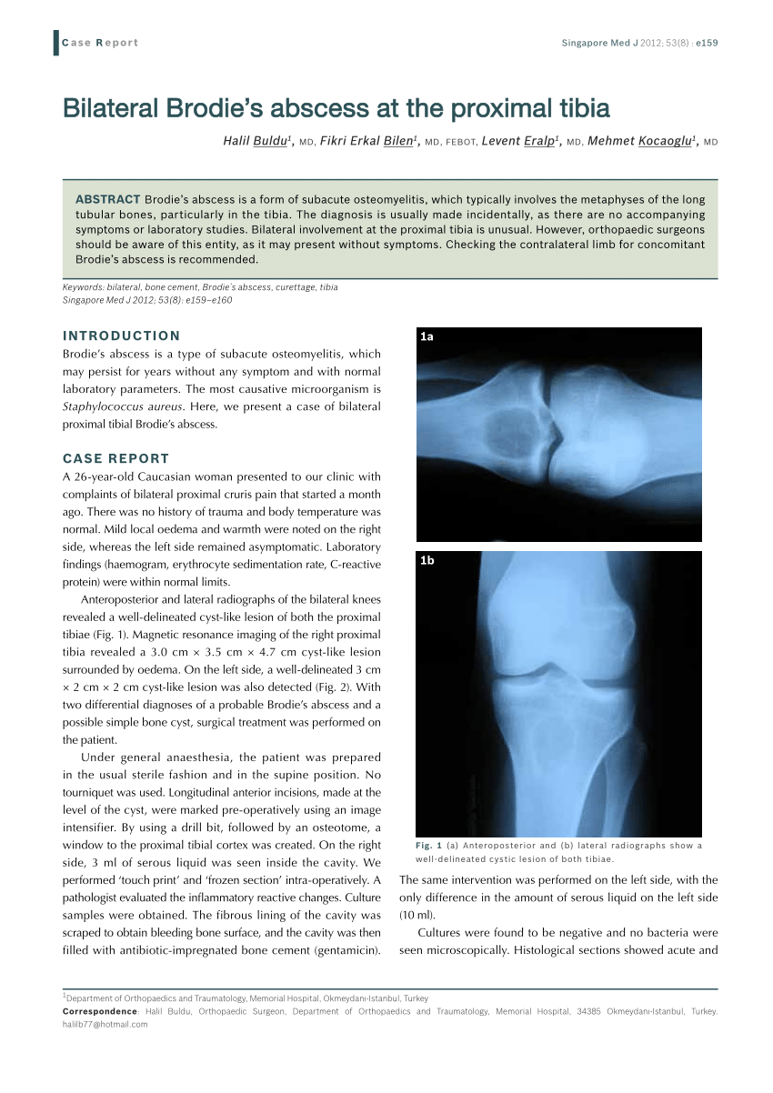 PDF Bilateral Brodie s abscess at the proximal tibia