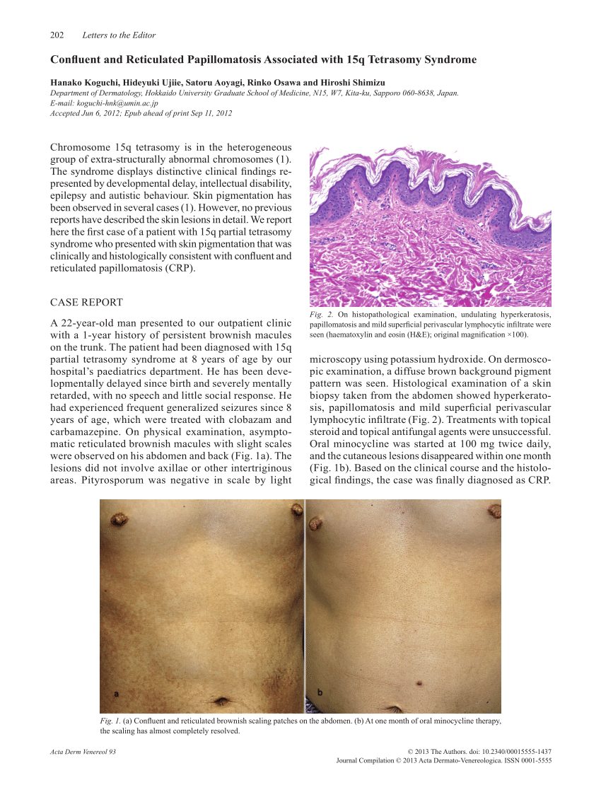 Histopathology of confluent and reticulated papillomatosis