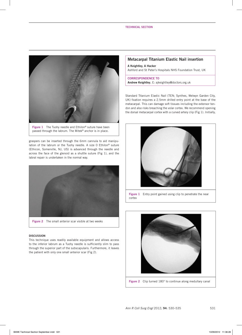 PDF) Metacarpal Titanium Elastic Nail insertion