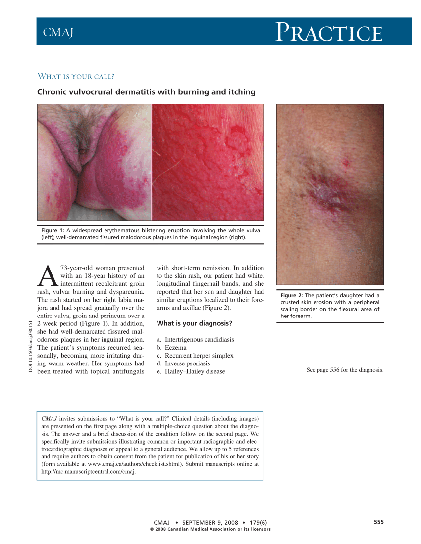 Inguinalis dermatitis: hogyan jelentkezik a betegség és hogyan kezeljük azt - Típusok April