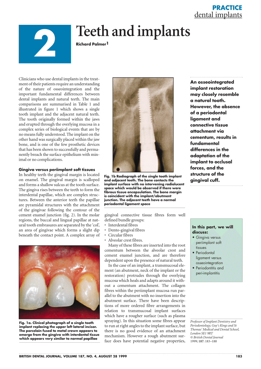 research paper on dental implants