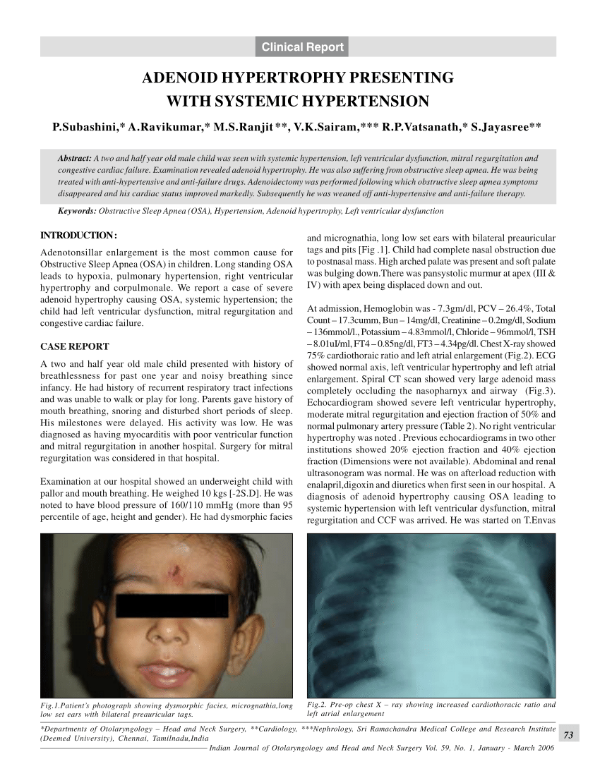 Pdf Adenoid Hypertrophy Presenting With Systemic Hypertension