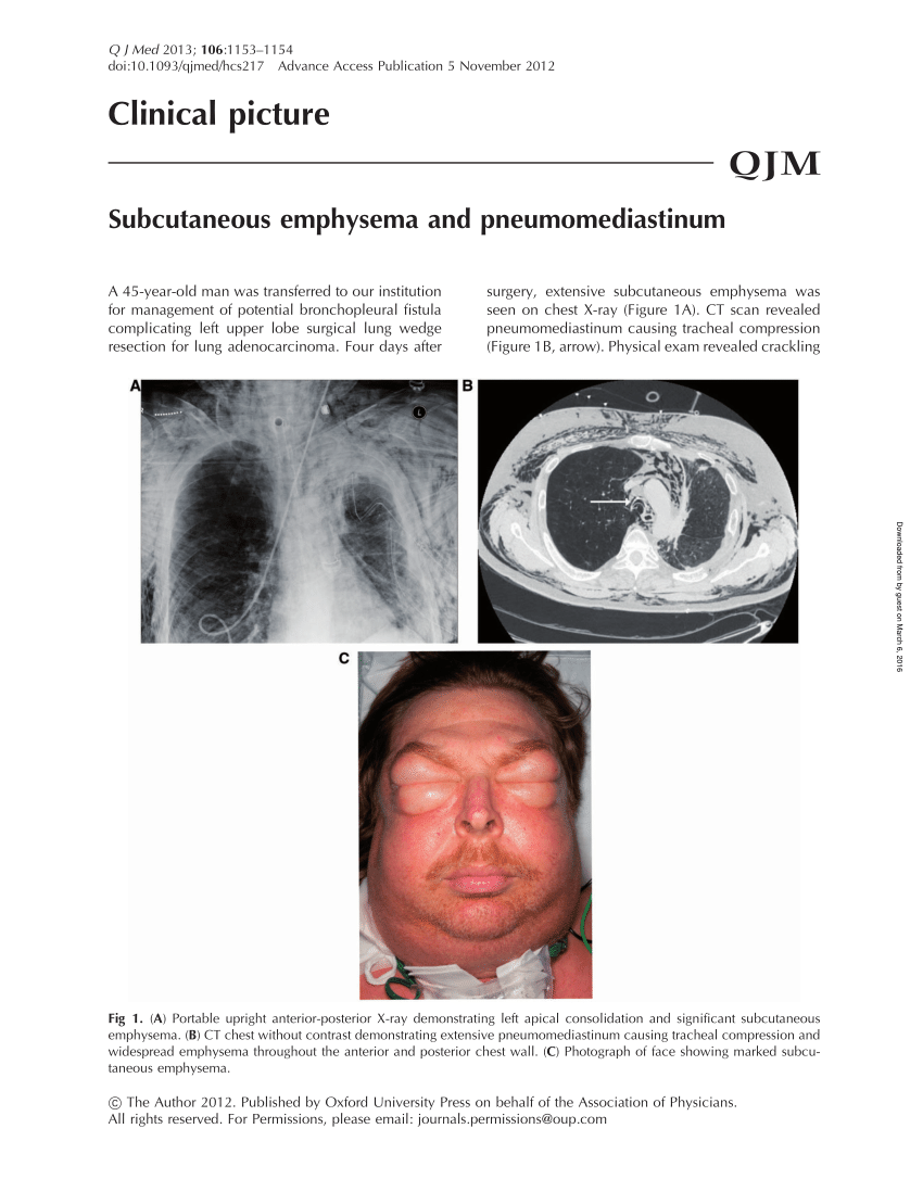 Pdf Subcutaneous Emphysema And Pneumomediastinum