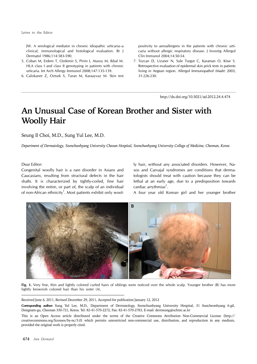 Uncombable Hair Syndrome How to Identify and Help Children With this Rare  Disorder