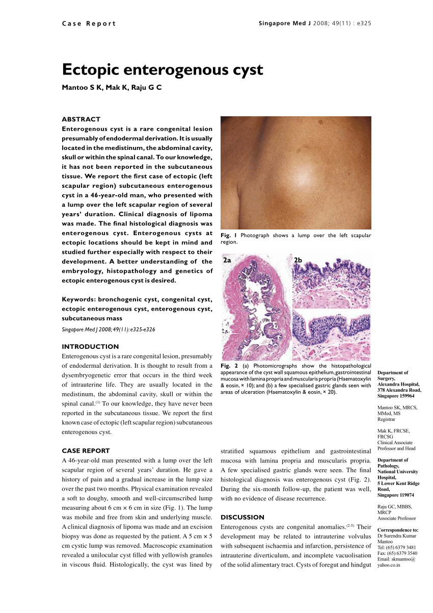 Double intraspinal enterogenous cysts.