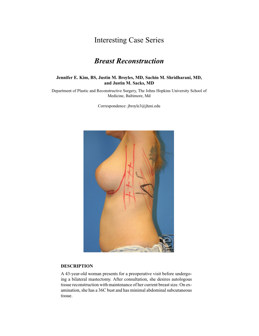 Mastectomy  Johns Hopkins Medicine