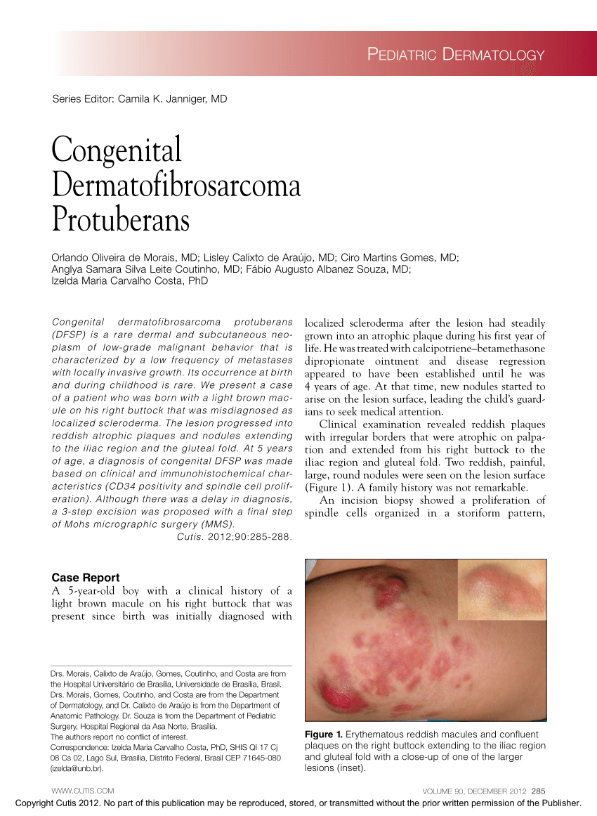 PDF Congenital Dermatofibrosarcoma Protuberans