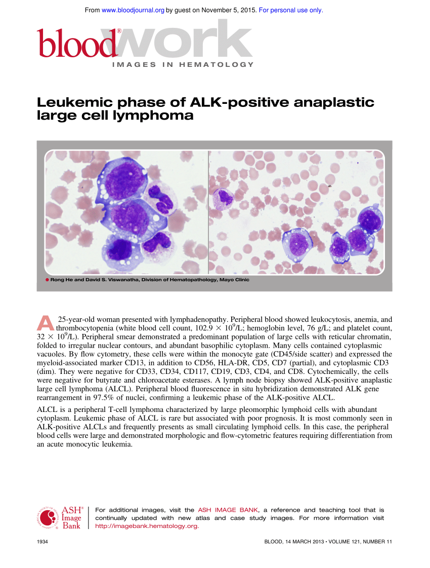 Pdf Leukemic Phase Of Alk Positive Anaplastic Large Cell Lymphoma