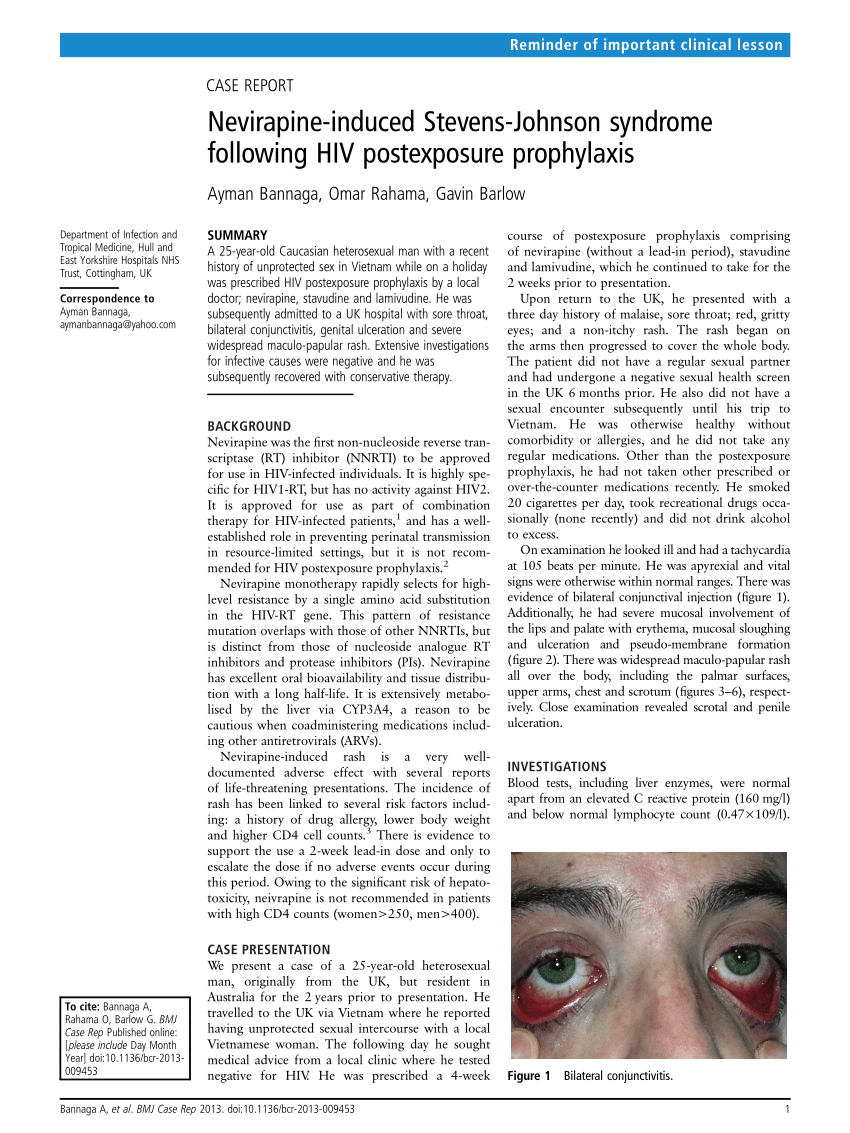 PDF Nevirapine induced Stevens Johnson syndrome following HIV  