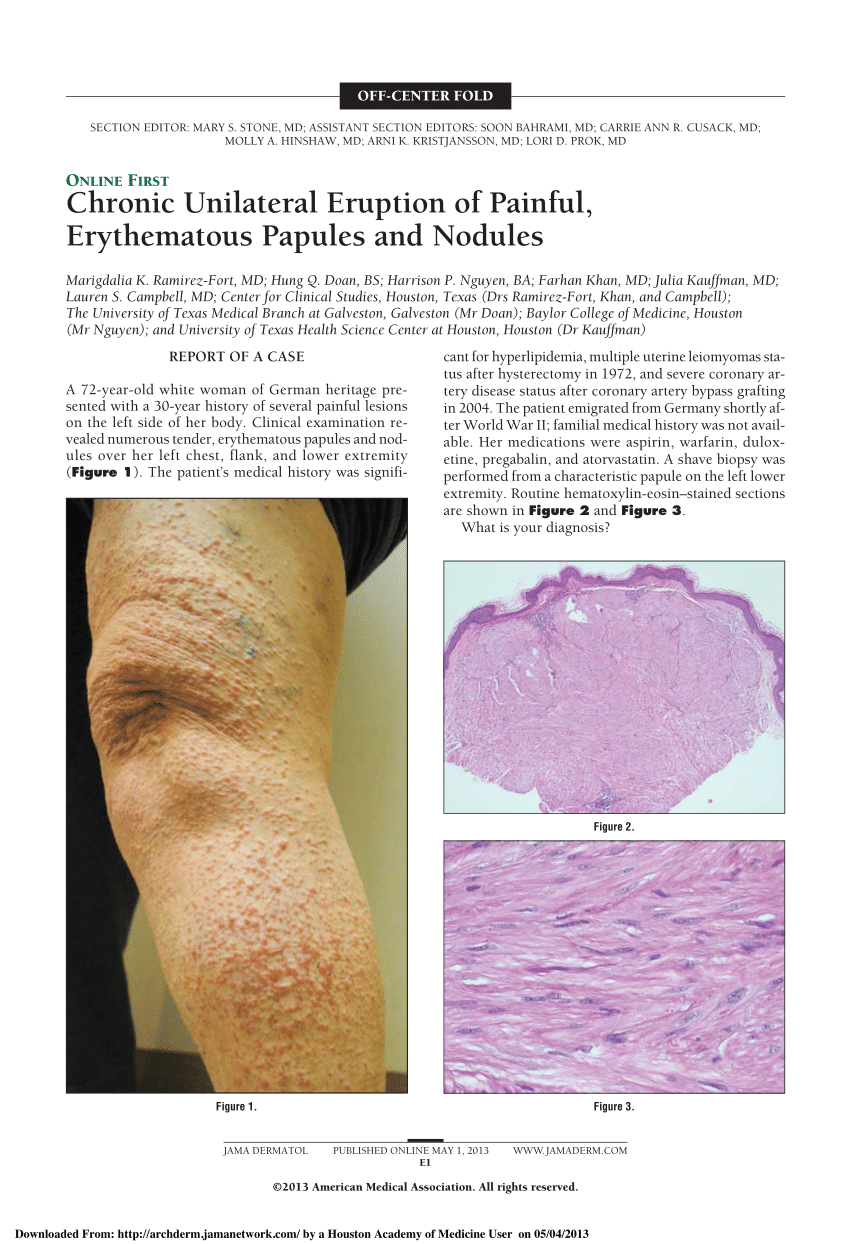 Pdf Chronic Unilateral Eruption Of Painful Erythematous Papules And