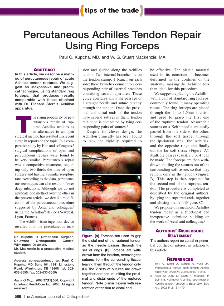 Pdf Percutaneous Achilles Tendon Repair Using Ring Forceps