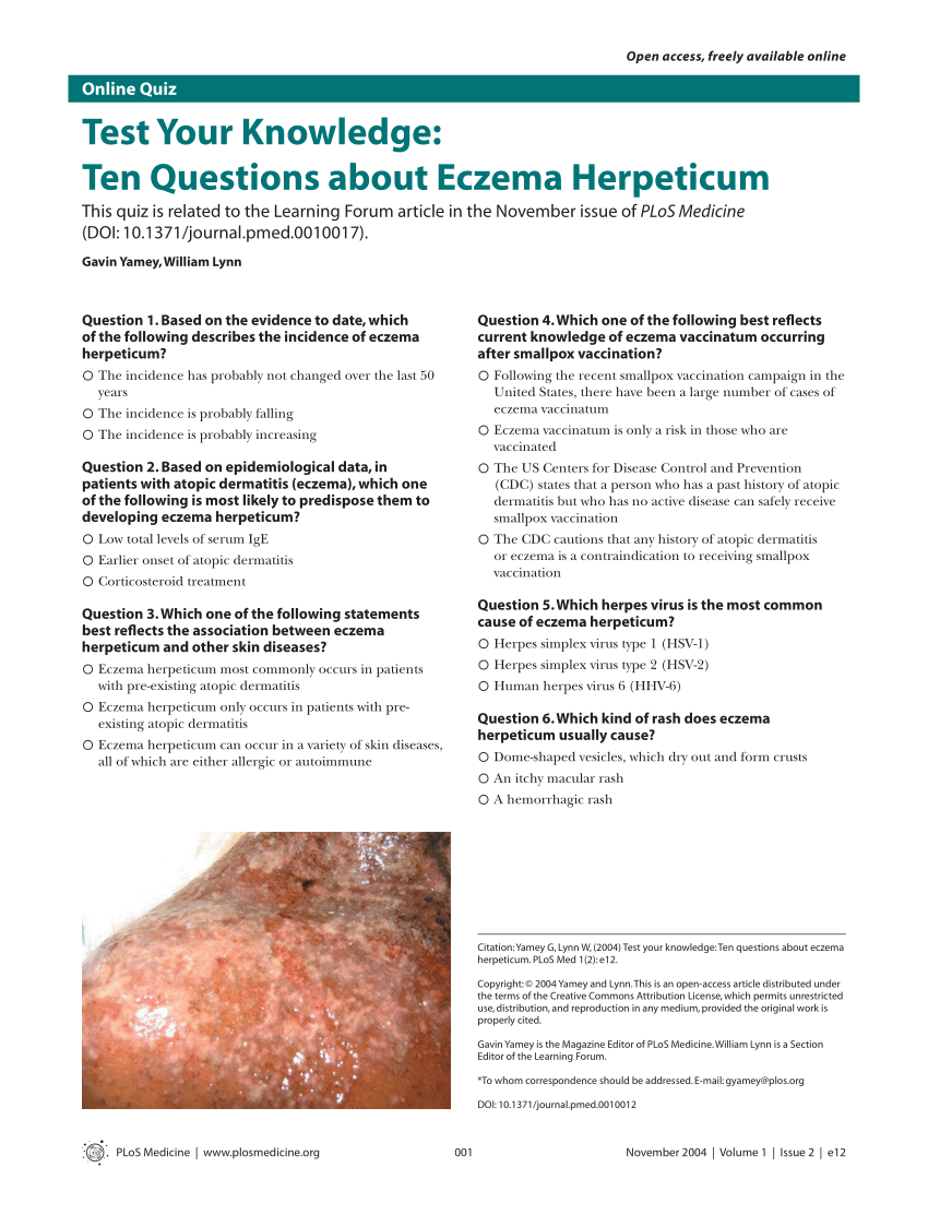 Pdf Test Your Knowledge Ten Questions About Eczema Herpeticum