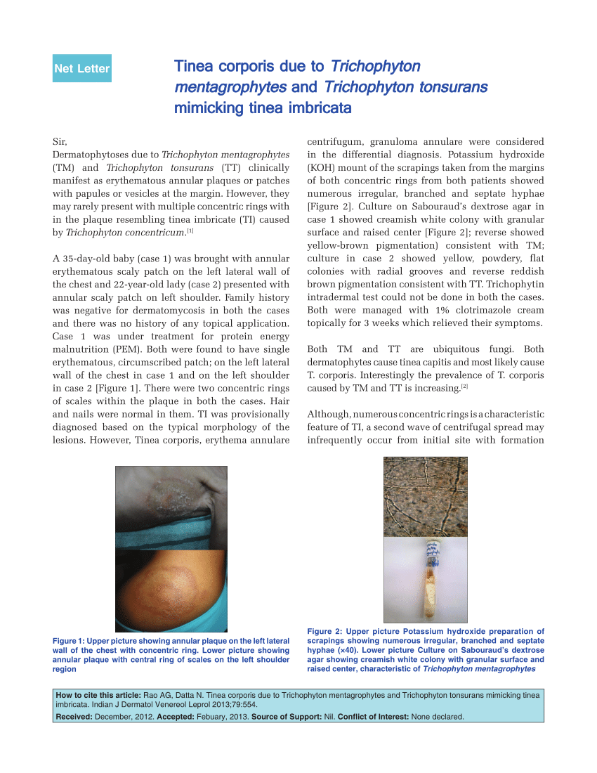 PDF] Tinea Manuum Caused by Trichophyton mentagrophytes var
