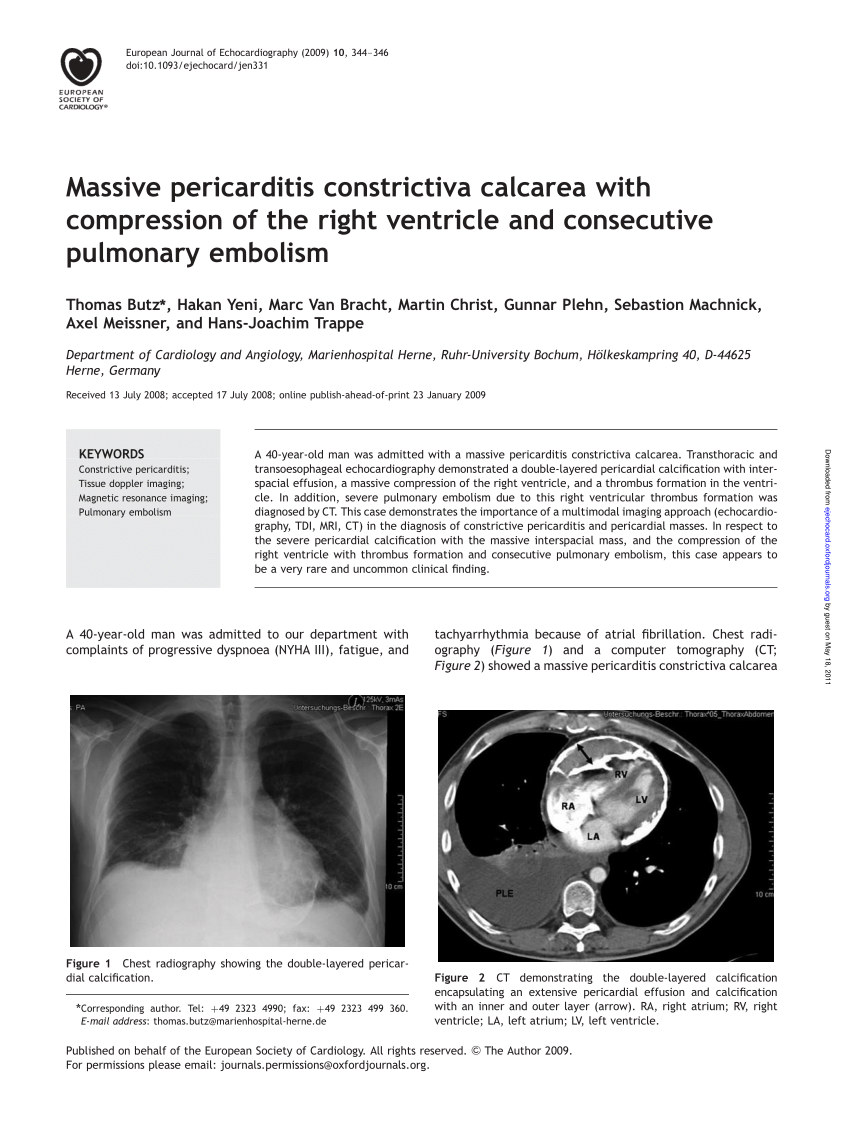 Pdf Massive Pericarditis Constrictiva Calcarea With Compression Of The Right Ventricle And Consecutive Pulmonary Embolism