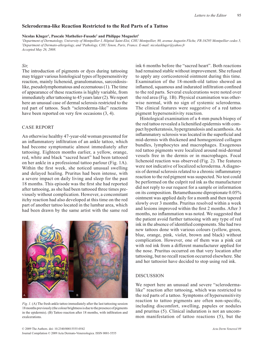 Systemic diseases and infections anecdotal complications and oddities  associated with tattooing