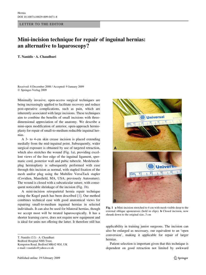 Pdf Mini Incision Technique For Repair Of Inguinal Hernias An