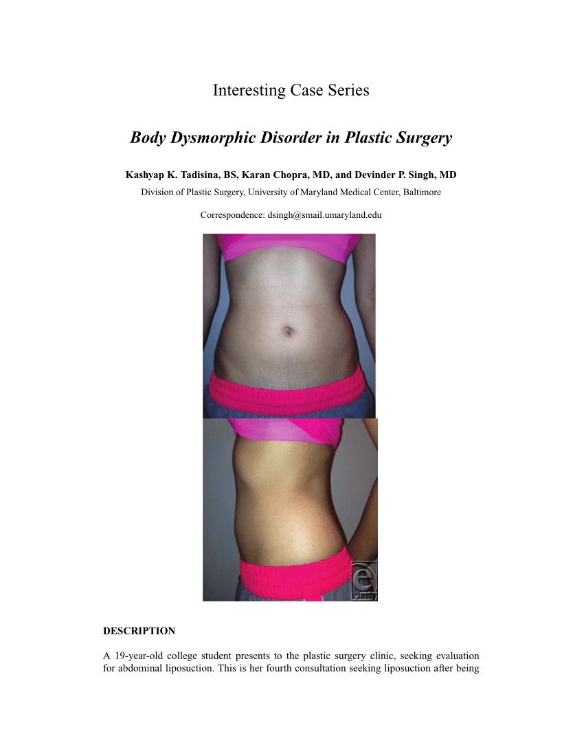 PDF) Body Dysmorphic Disorder in Plastic Surgery