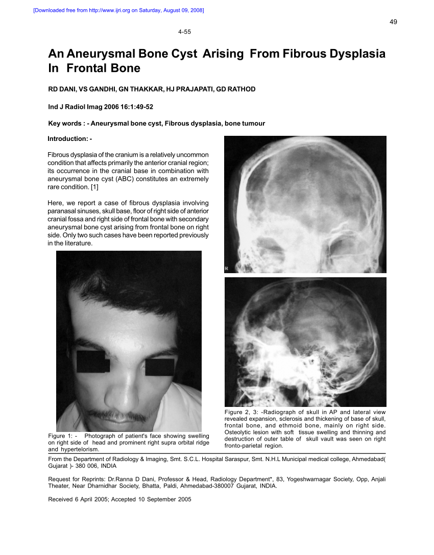 Pdf An Aneurysmal Bone Cyst Arising From Fibrous Dysplasia In Frontal