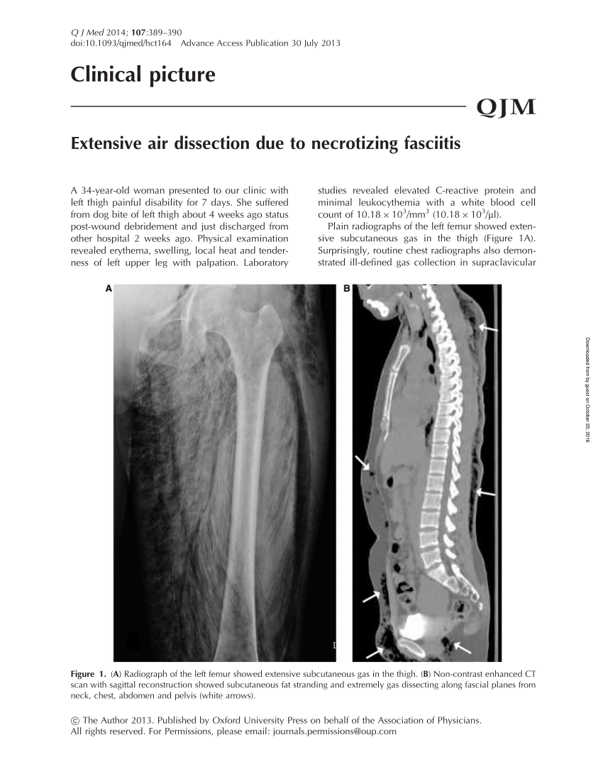 Pdf Extensive Air Dissection Due To Necrotizing Fasciitis