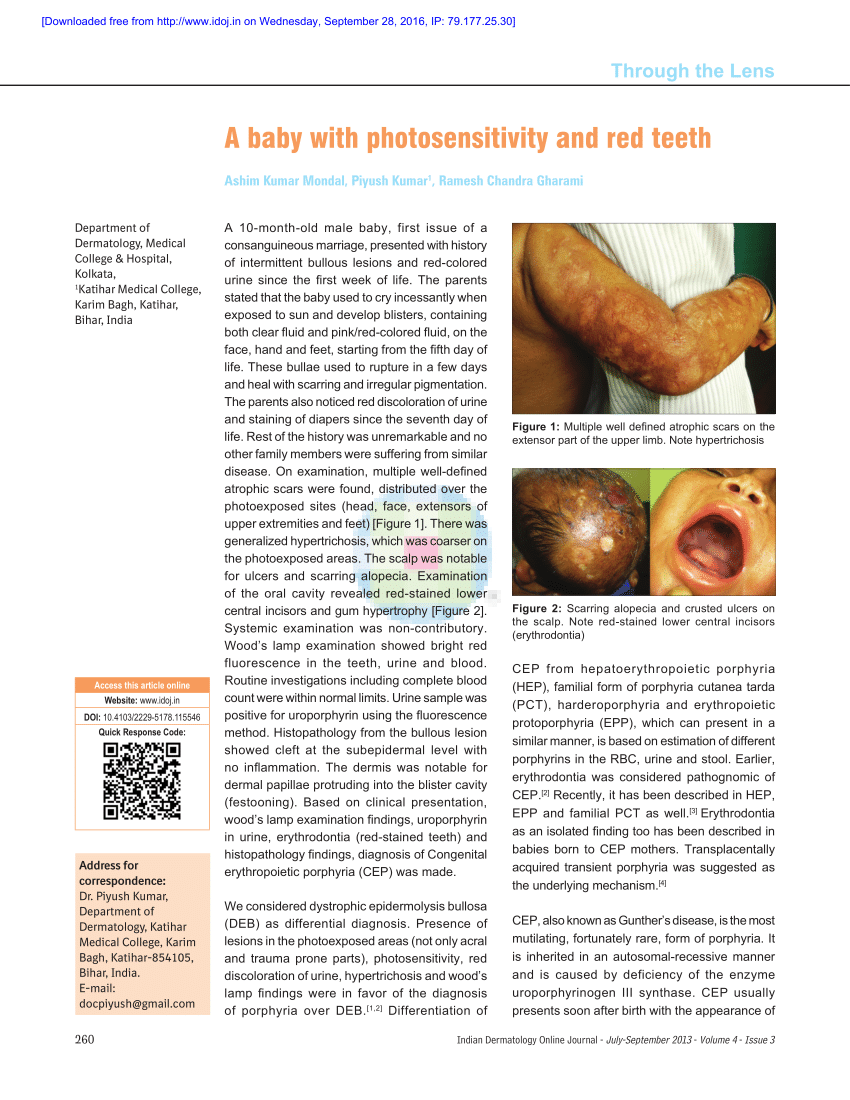 Approach to inherited hypertrichosis: A brief review - Indian