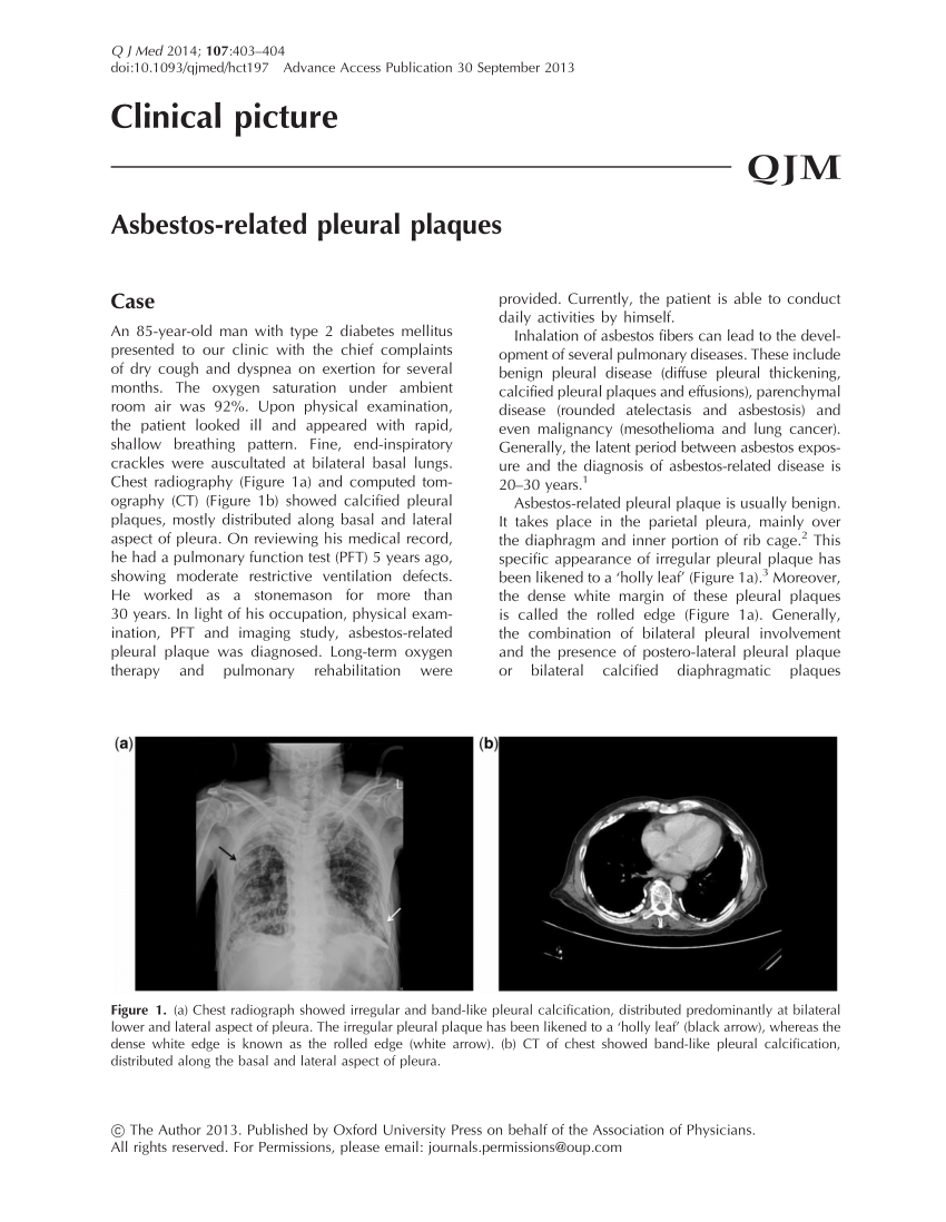 Pdf Asbestos Related Pleural Plaques