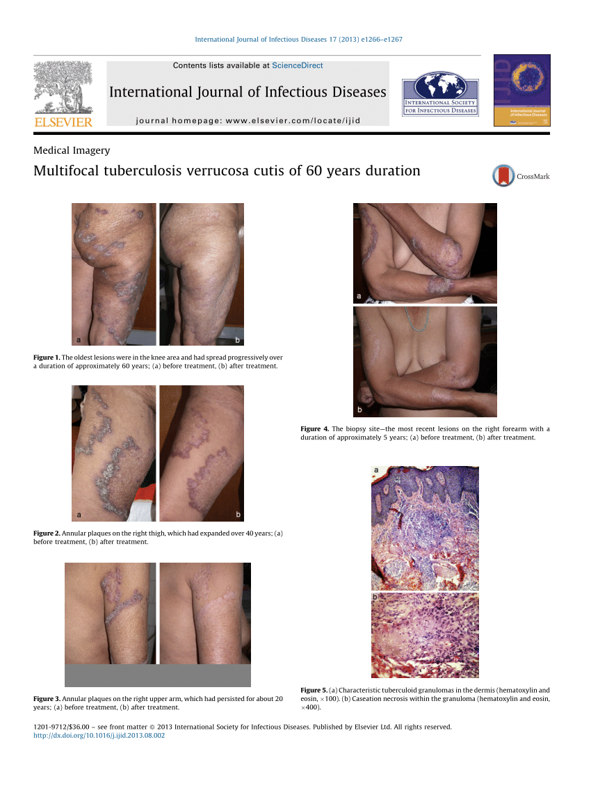 Pdf Multifocal Tuberculosis Verrucosa Cutis Of 60 Years Duration