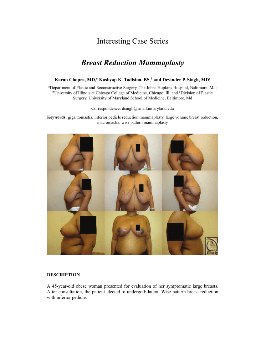 PDF) Breast Reduction Mammaplasty