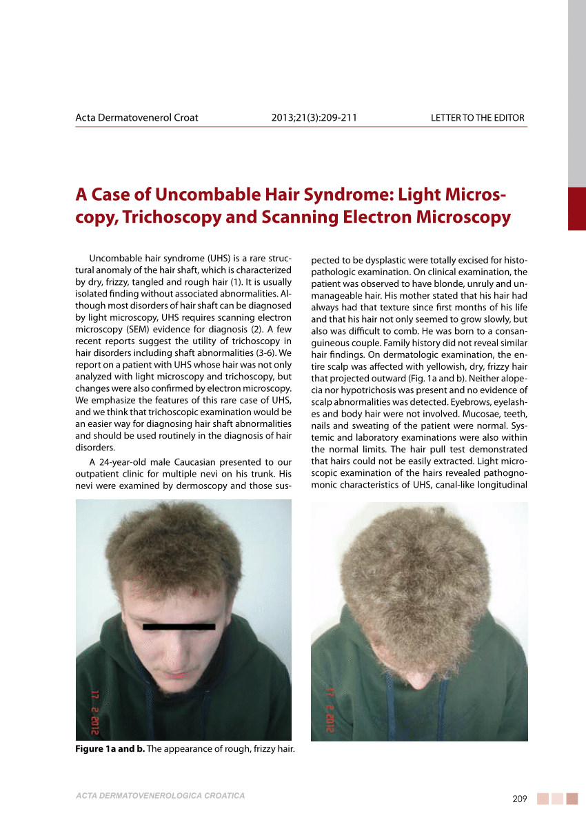 PDF) A Case of Uncombable Hair Syndrome: Light Microscopy, Trichoscopy and  Scanning Electron Microscopy