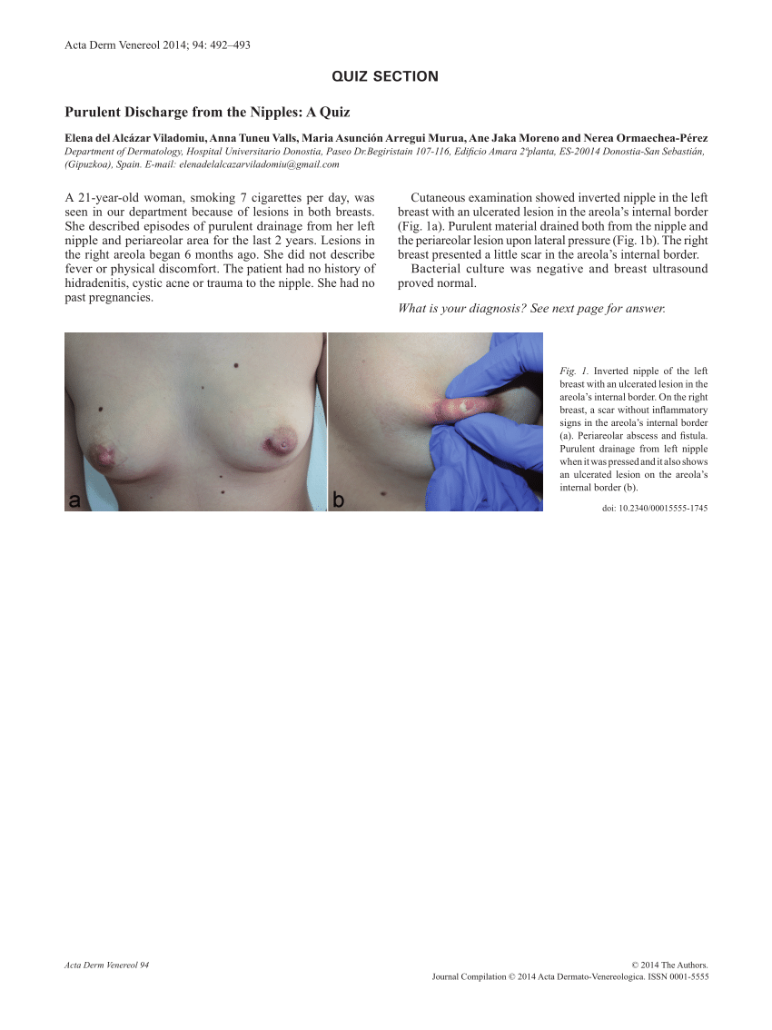 PDF] Breast Pain , Nipple Pain and Nipple Discharge – An Overview