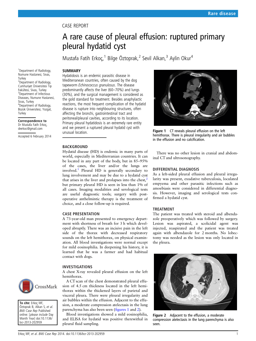 Pdf A Rare Cause Of Pleural Effusion Ruptured Primary Pleural