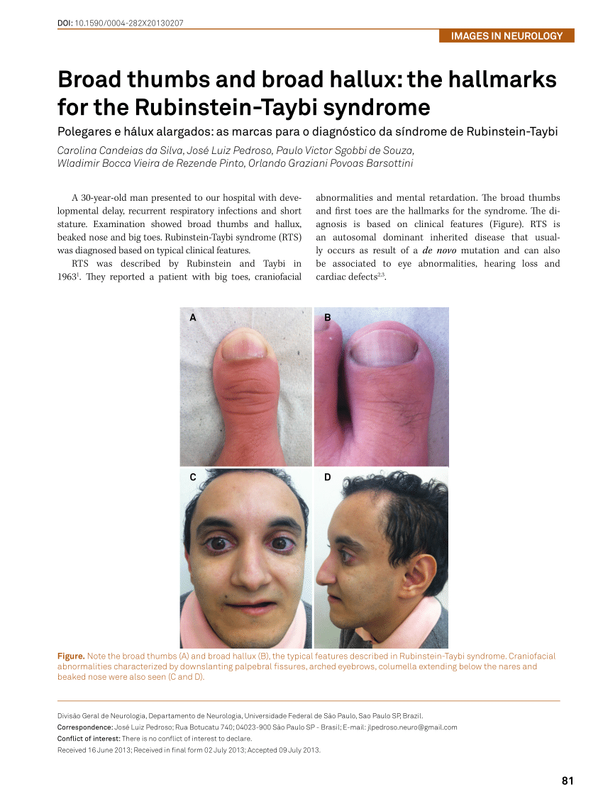 RUBINSTEIN TAYBI SYNDROME An autosomal dominant disease associated