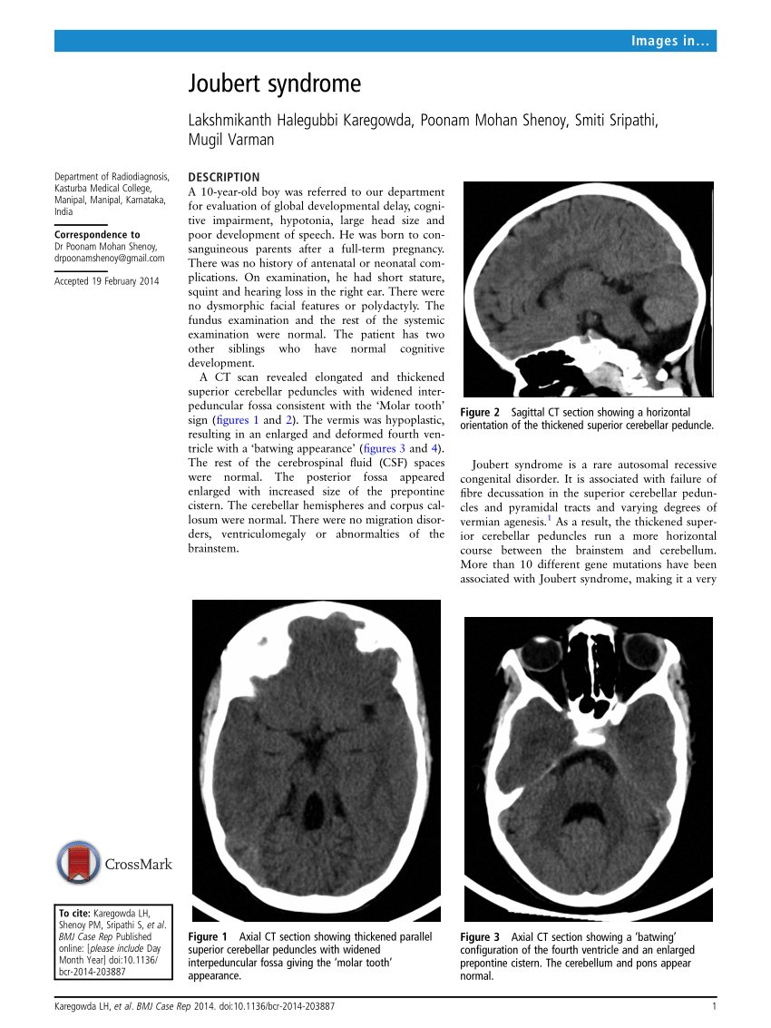 Joubert syndrome что это